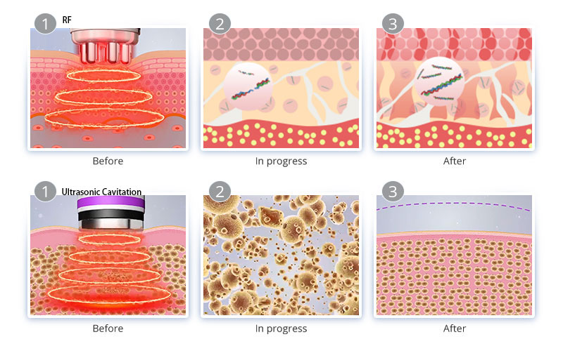 vacuum rf therapy before and after